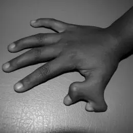 malformazione della mano