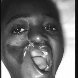 noma (cancrum oris) in bambina di 13 anni