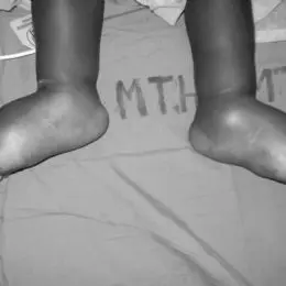 rara malformazione dei piedi in un bambino