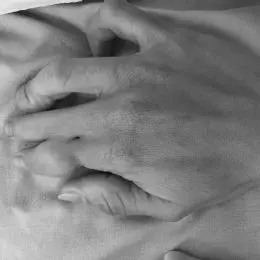 rara malformazione (iatrogena..) della mano