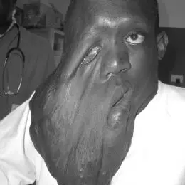 un caso di neurofibromatosi (malattia di von recklinghausen)