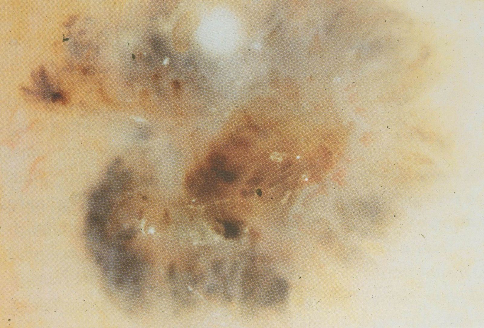 carcinoma