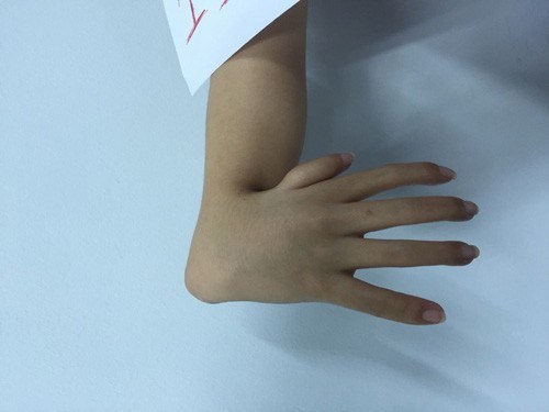 Gravi malformazioni delle mani