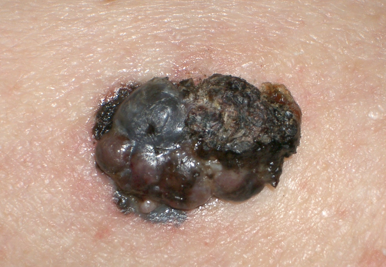 Melanome